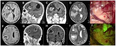 Combined Application of Sodium Fluorescein and Neuronavigation Techniques in the Resection of Brain Gliomas